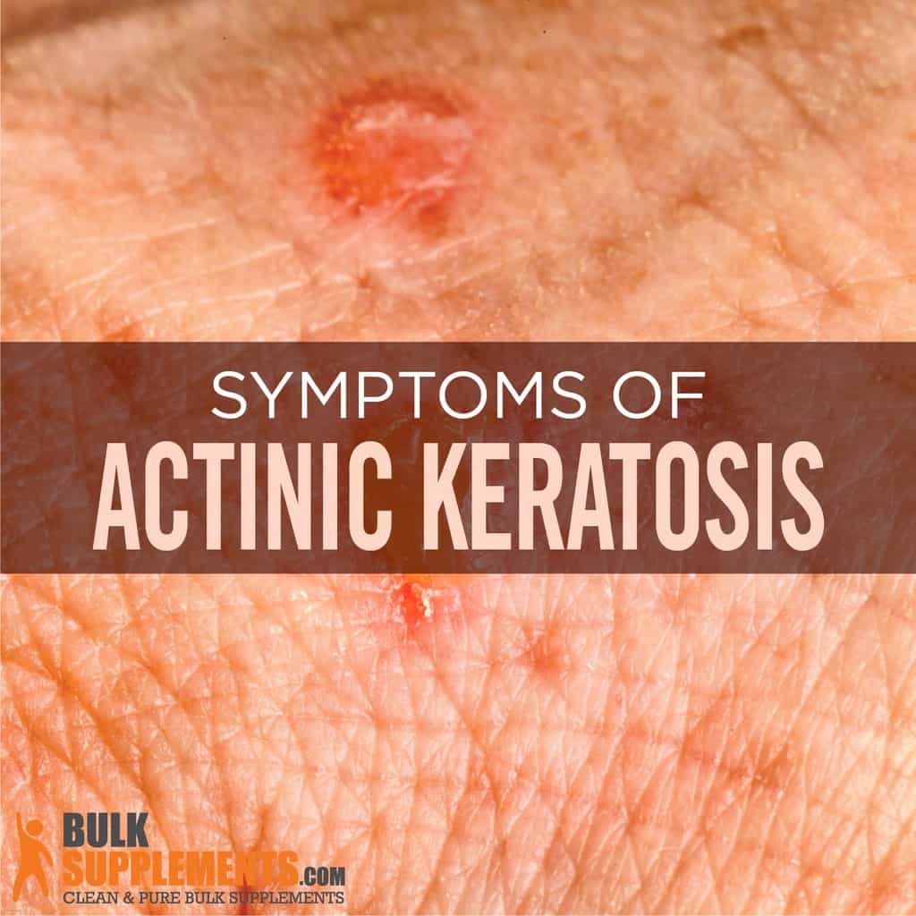 Skin Cancer Actinic Keratosis Hand