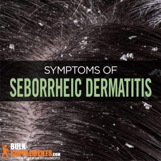 Seborrheic Dermatitis Symptoms Causes Treatment 13395 Hot Sex Picture