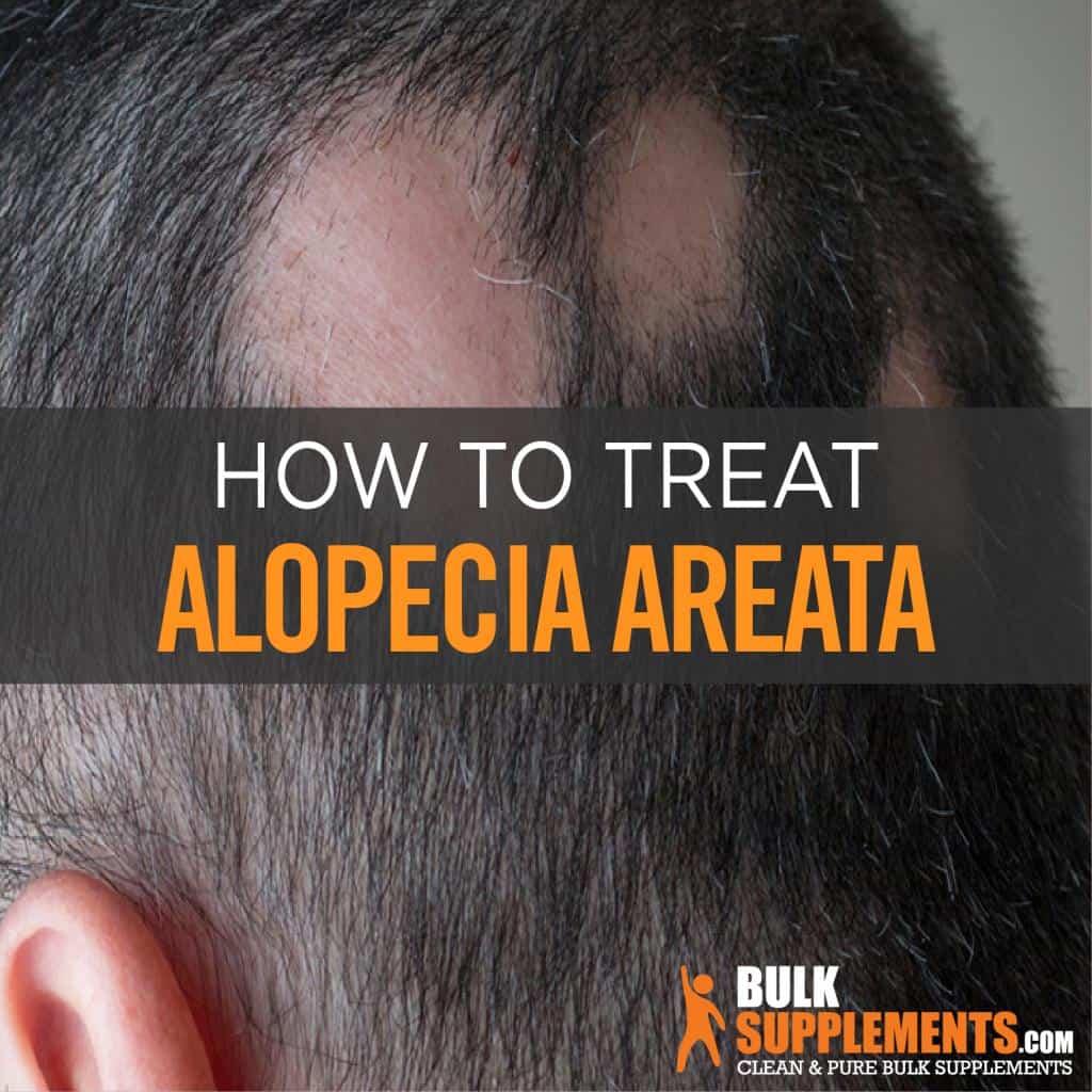 Alopecia Areata: What Causes Male Pattern Baldness?