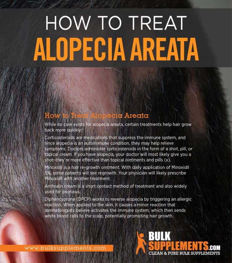 Alopecia Areata: What Causes Male Pattern Baldness?