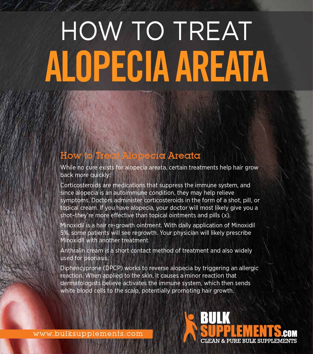 Alopecia Causes Types How To Treat By James Denlinger