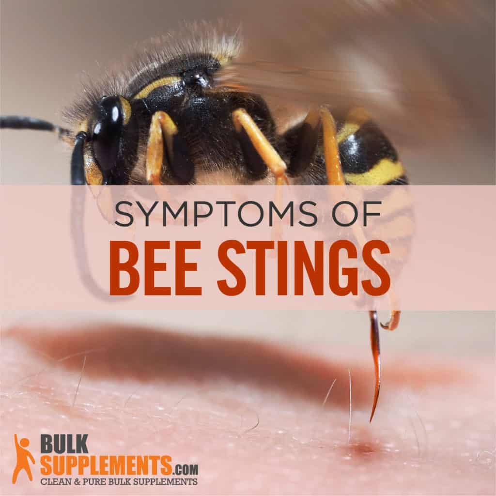 Bee Stings Characteristics Causes Treatment