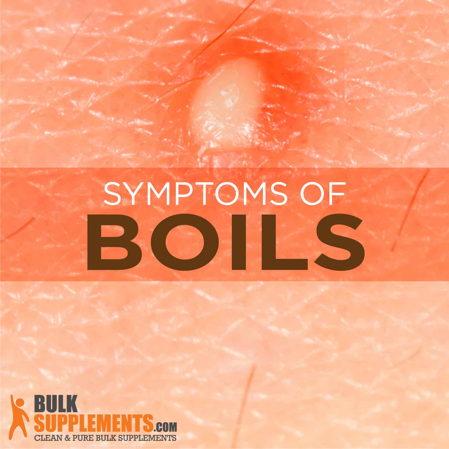 Boils Symptoms Causes And Treatment