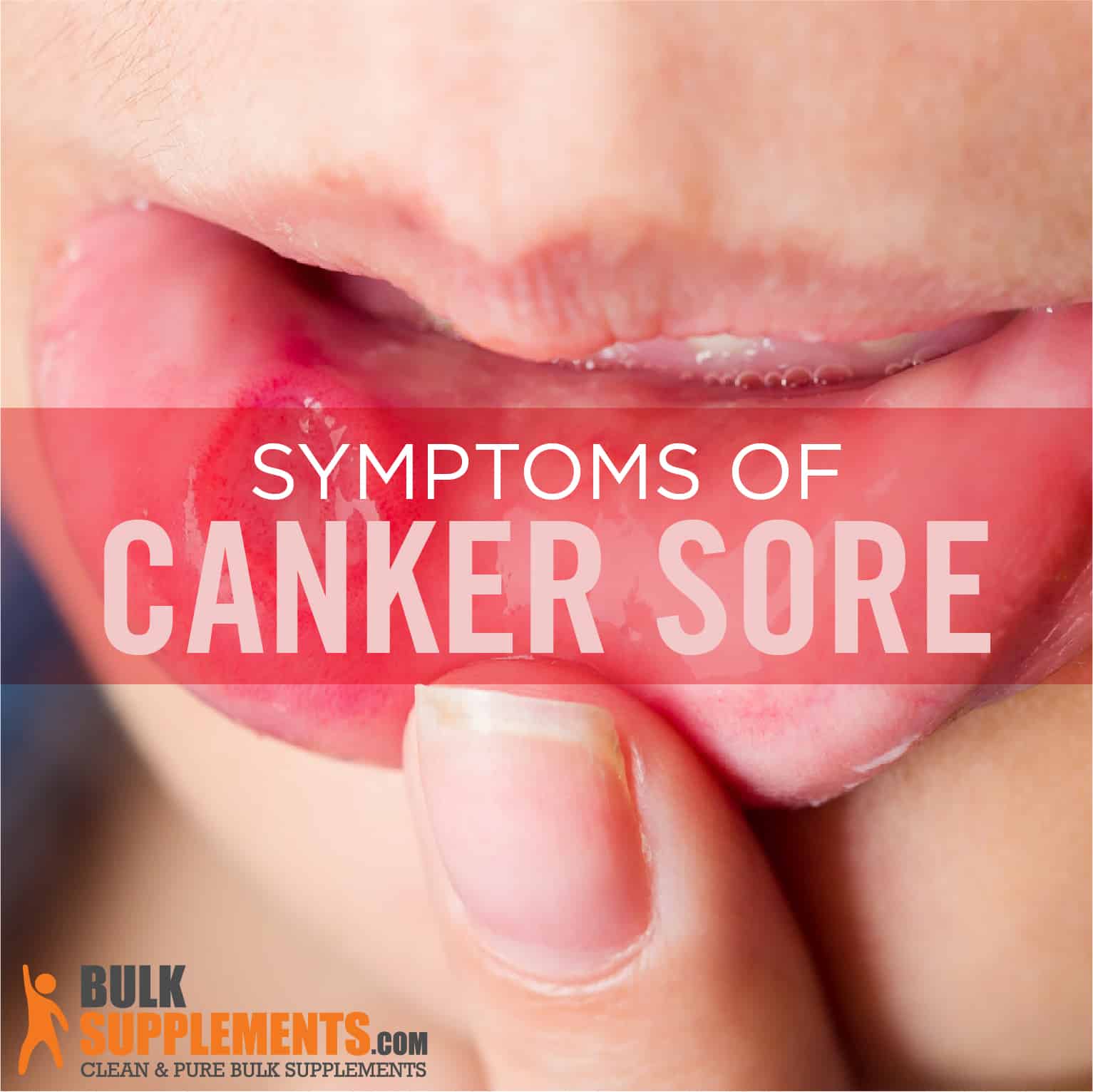 canker sore