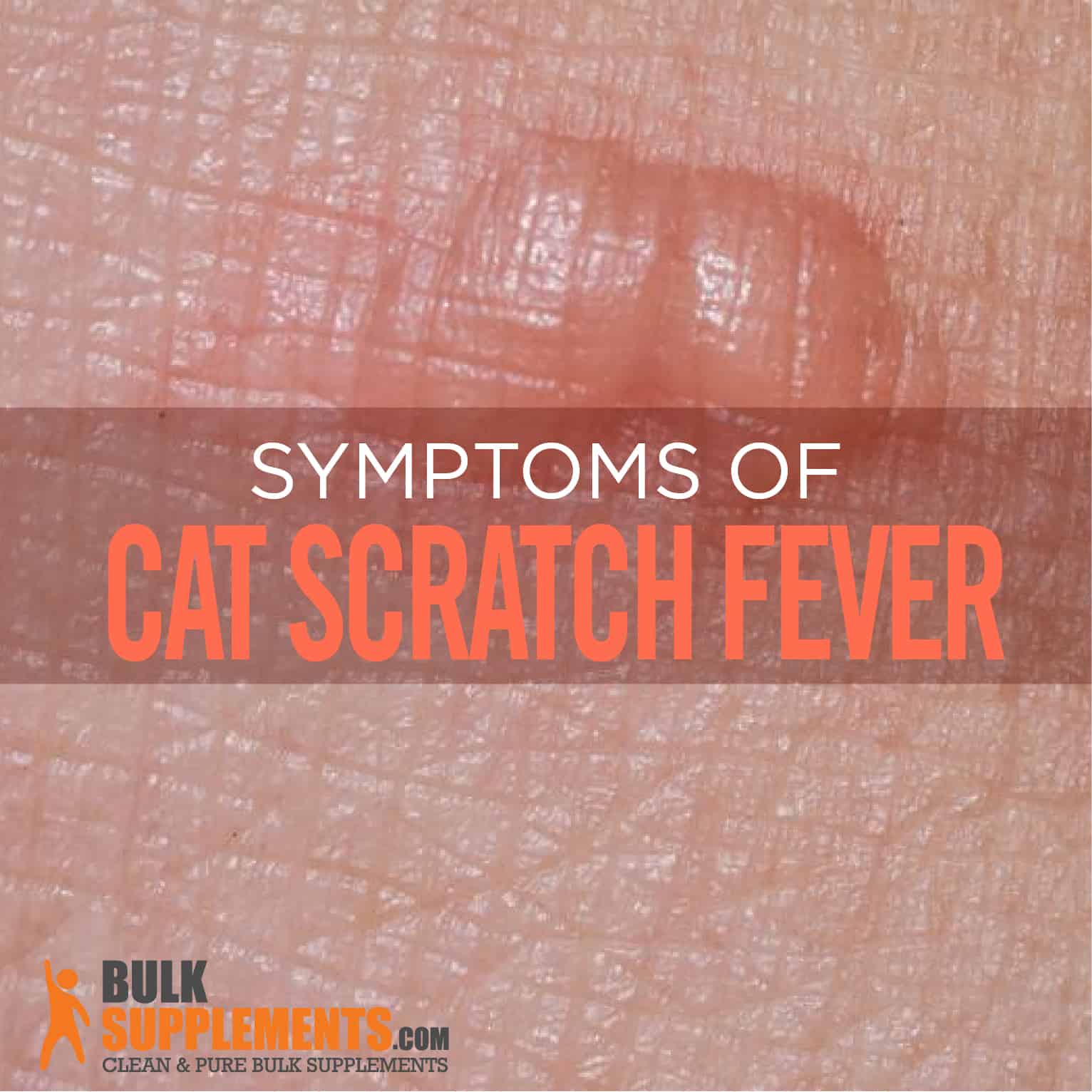 Cat Scratch Disease Causes Symptoms And Treatment Vlrengbr