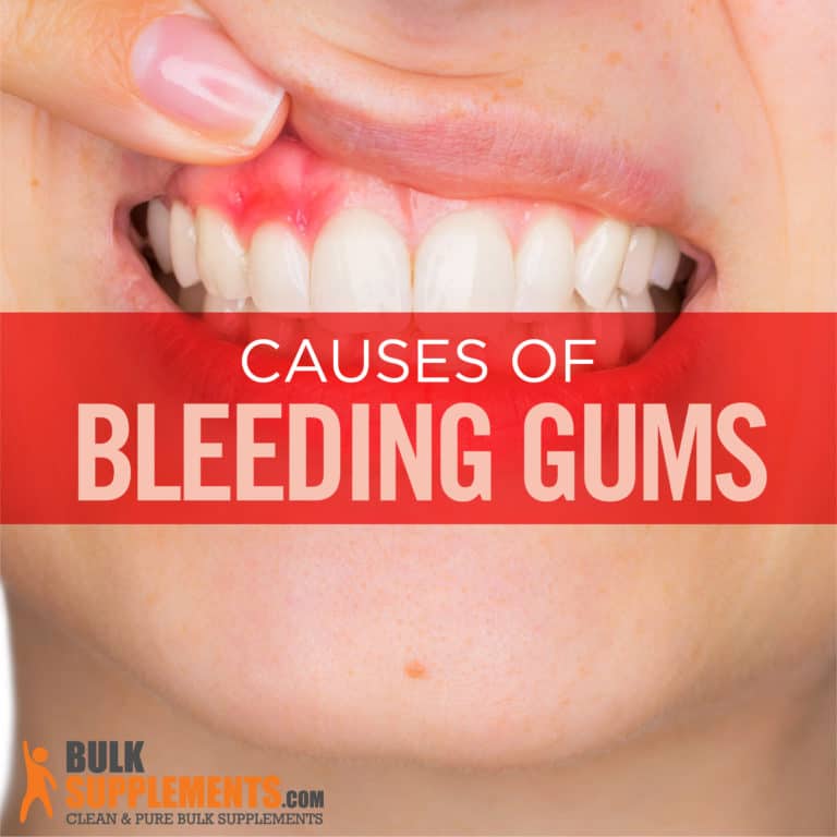 Bleeding Gums: Characteristics, Causes & Treatment