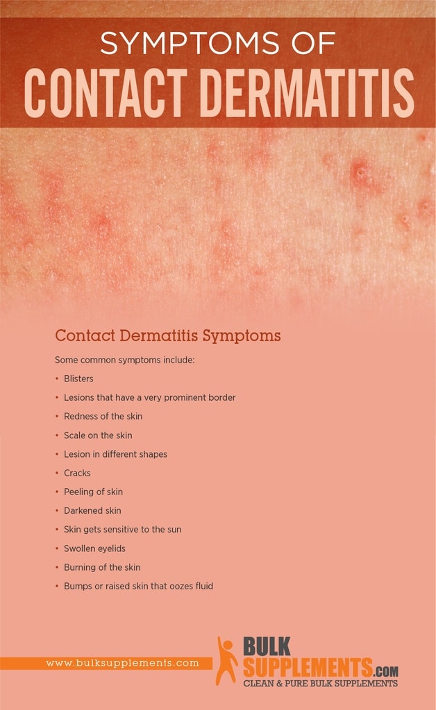 Contact Dermatitis Symptoms Causes Treatment By James Denlinger