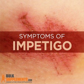 Impetigo: Symptoms, Causes & Treatment