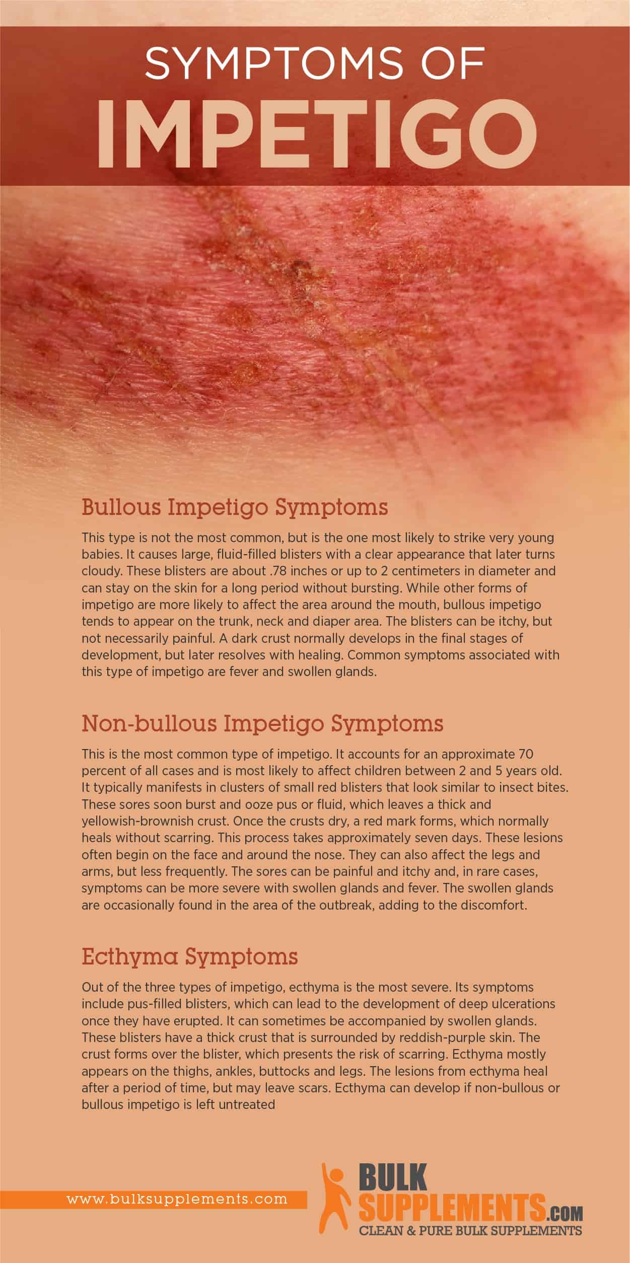 Impetigo Symptoms