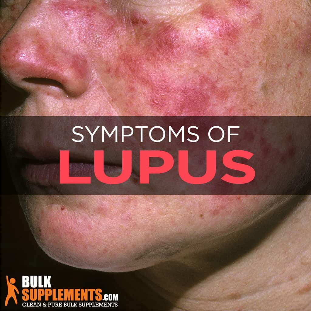 lupus headaches