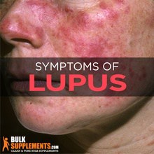 What is Lupus: Signs, Causes, Symptoms & Treatment