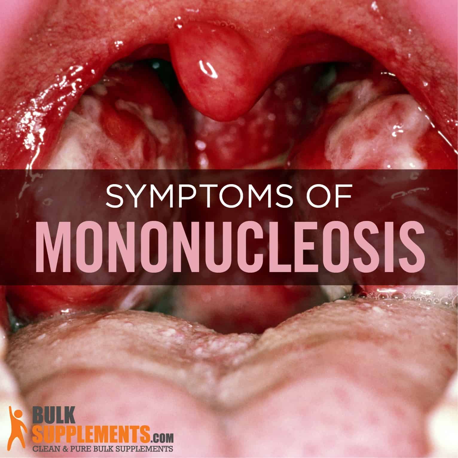 mononucleosis throat