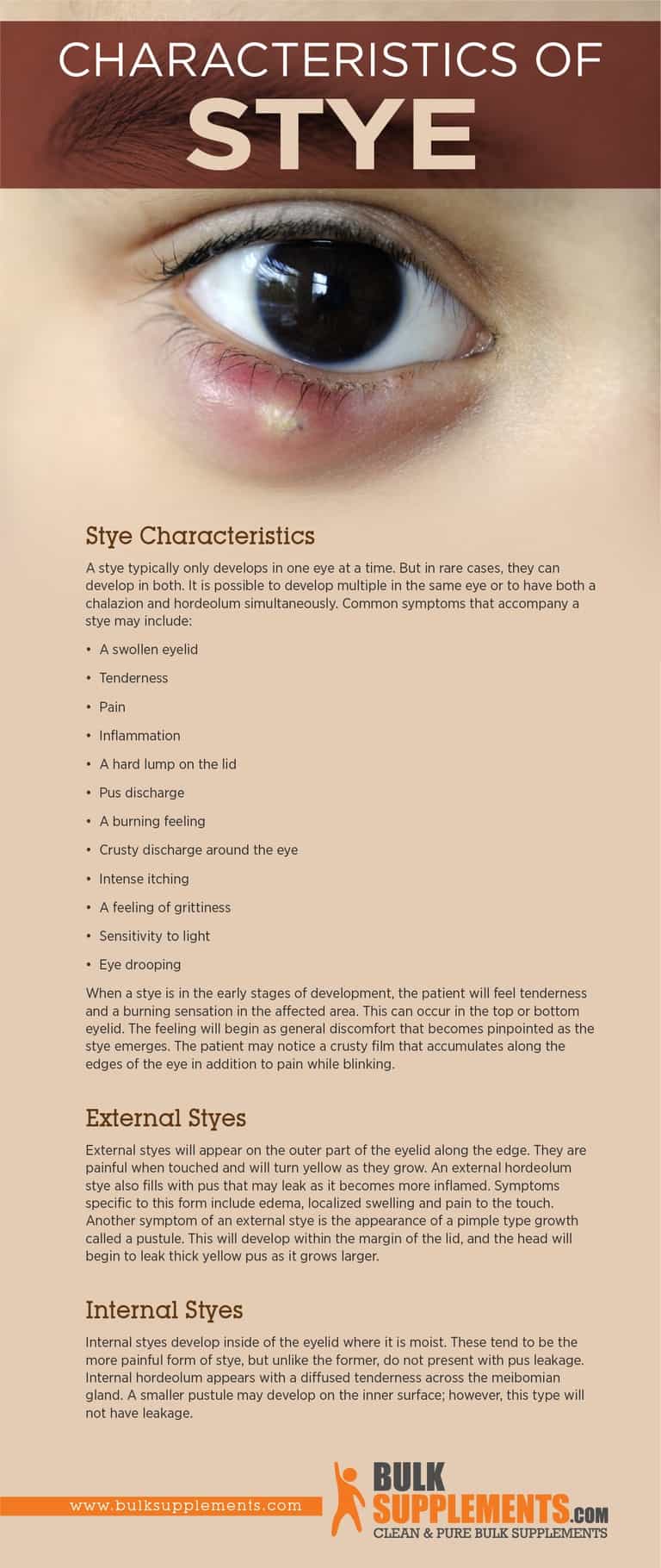 Stye Characteristics, Causes & Treatment