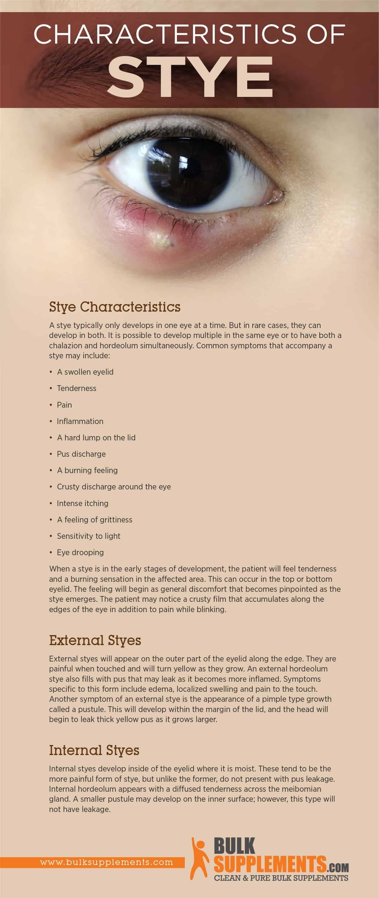 Stye Characteristics Causes And Treatment