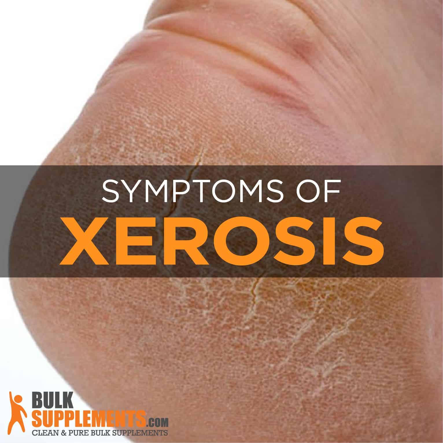 Xerosis Dry Skin Symptoms Causes Treatment