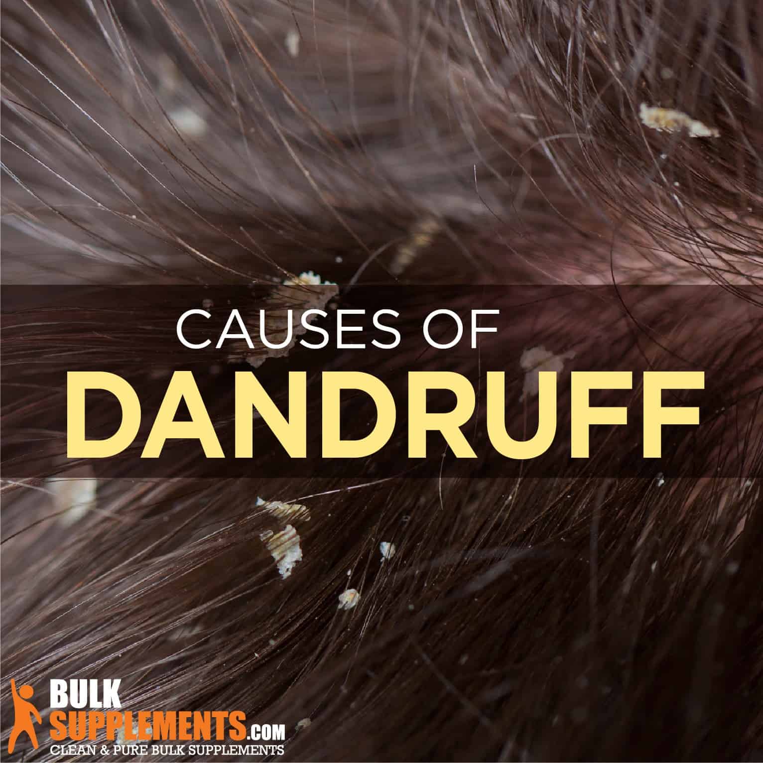 What is Dandruff: Causes, Symptoms & Treatment