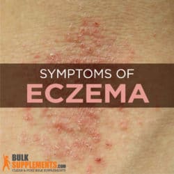 Eczema: Characteristics, Causes & Treatment