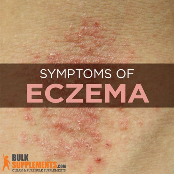 Eczema Characteristics Causes And Treatment 