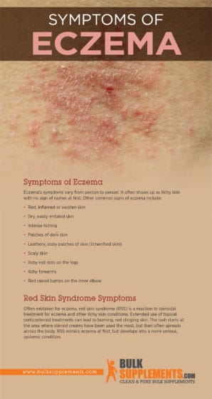 Eczema: Characteristics, Causes & Treatment