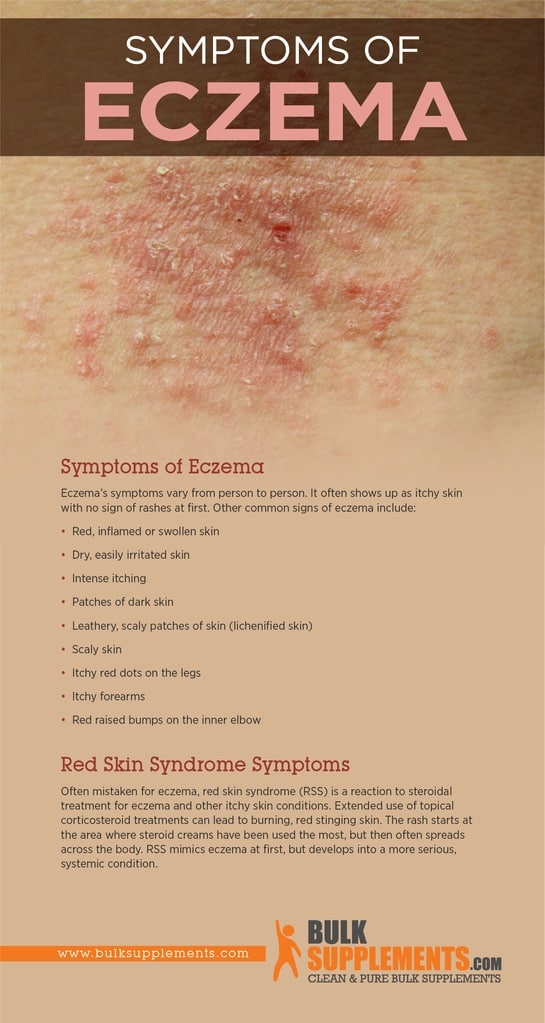 Eczema: Characteristics, Causes & Treatment