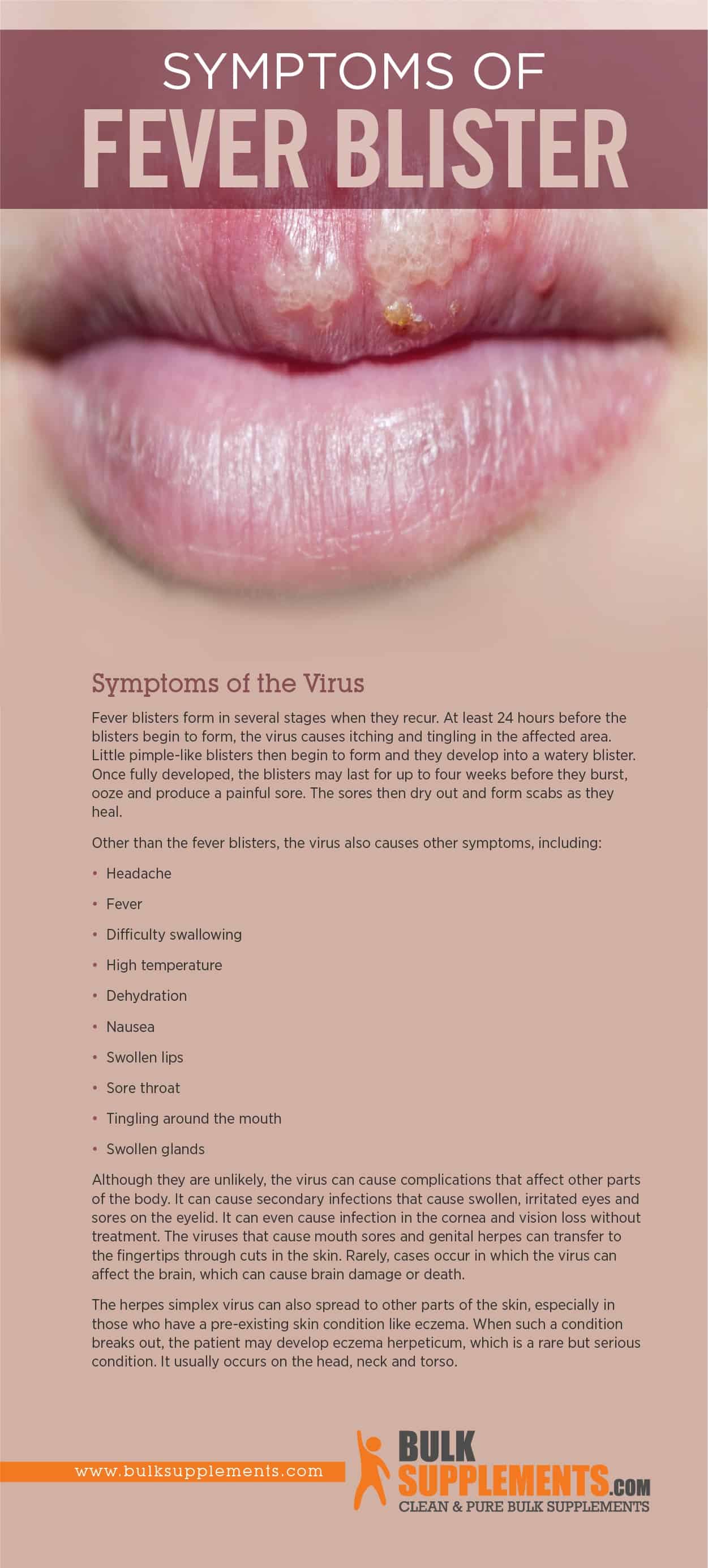 Fever Blister Symptoms