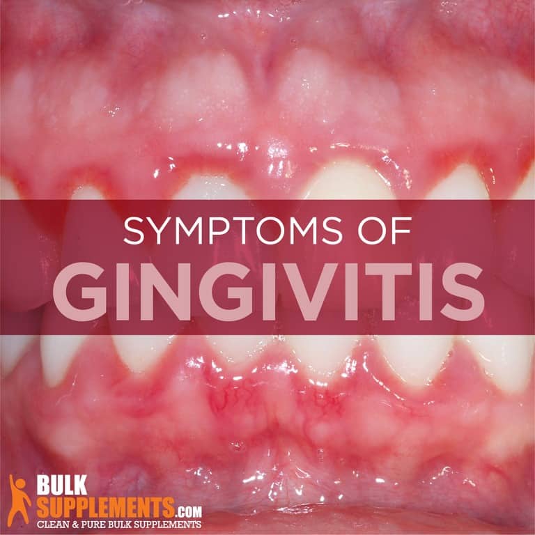 Gingivitis Symptoms, Causes & Treatment