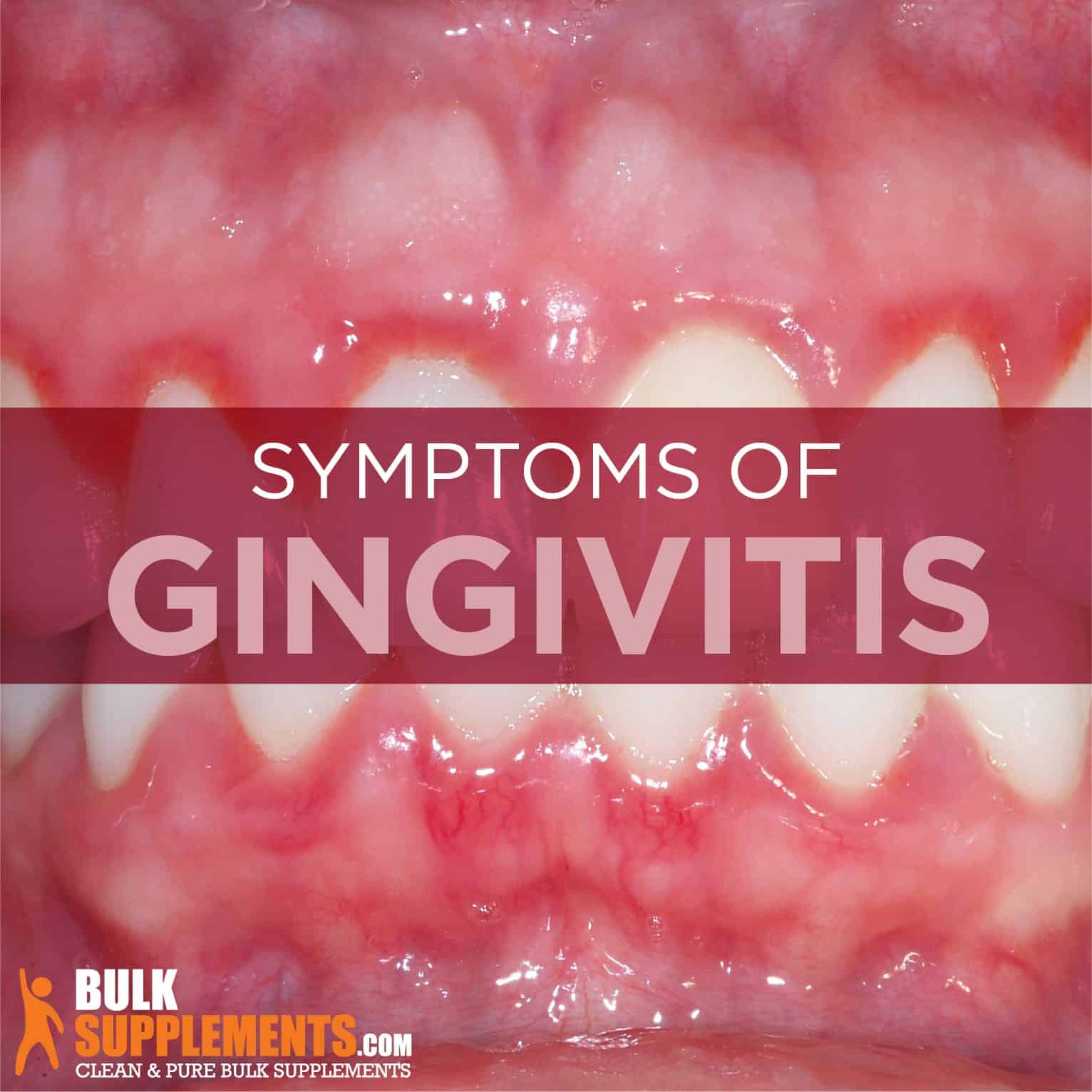 Gingivitis
