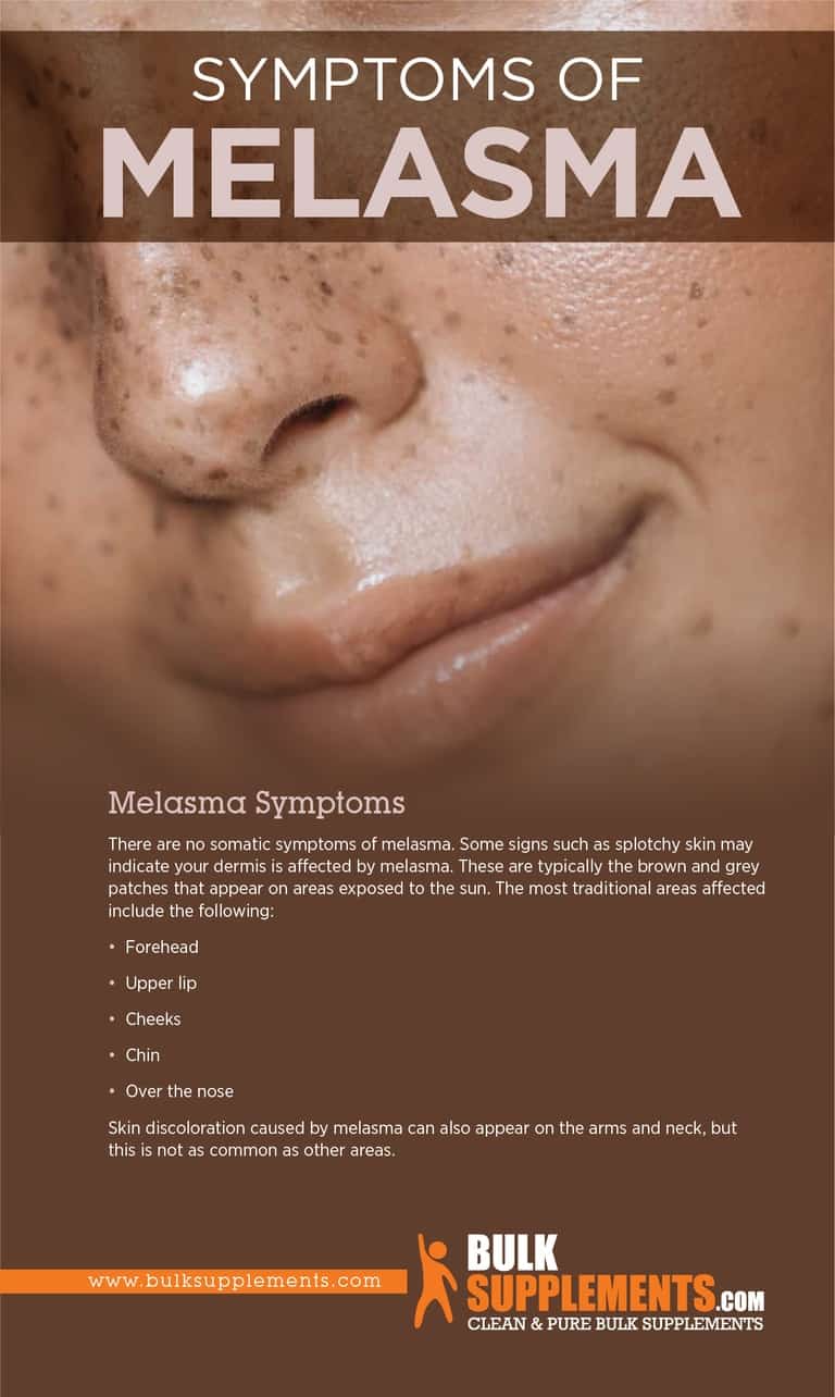 Melasma Symptoms Causes And Treatment