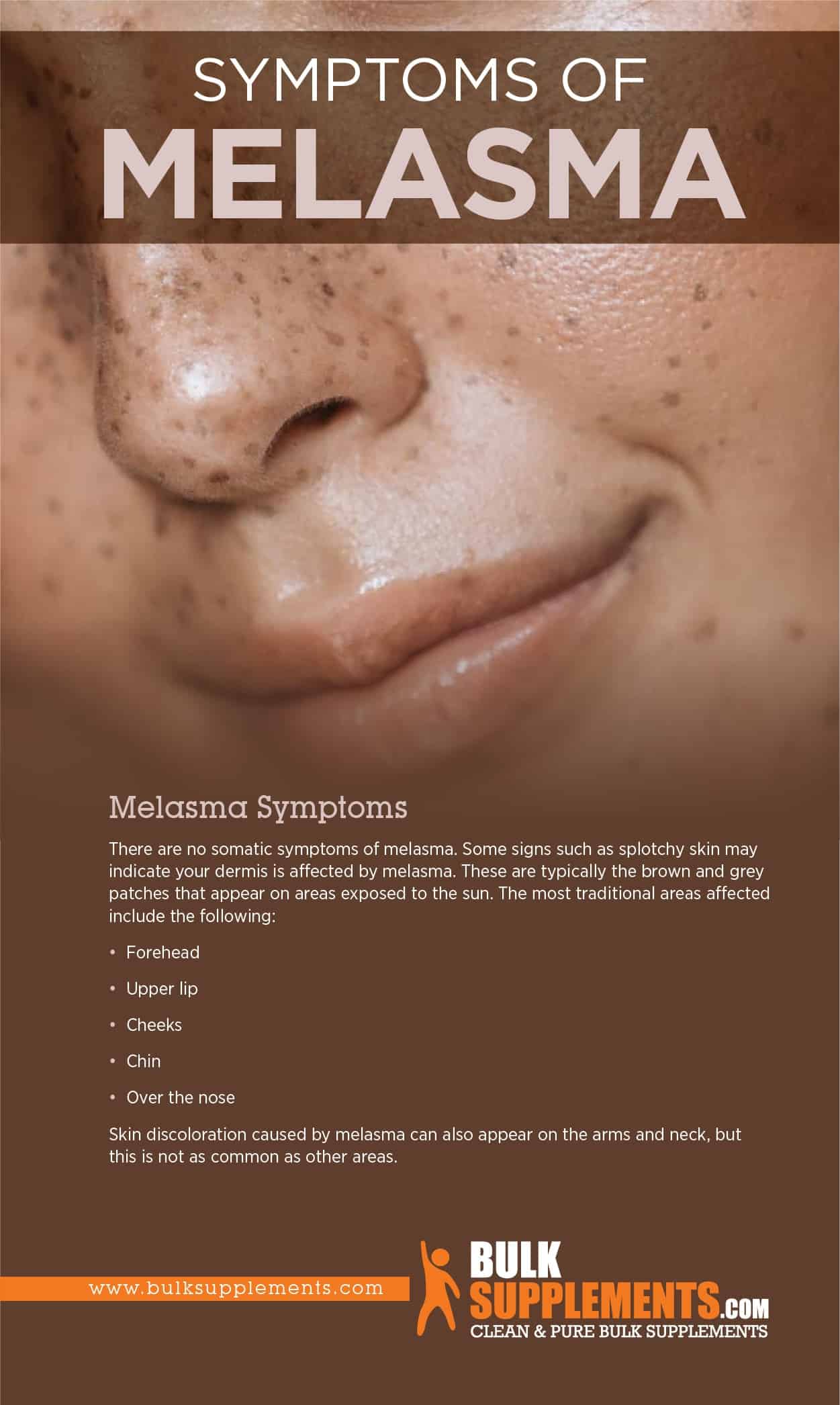 Melasma Symptoms