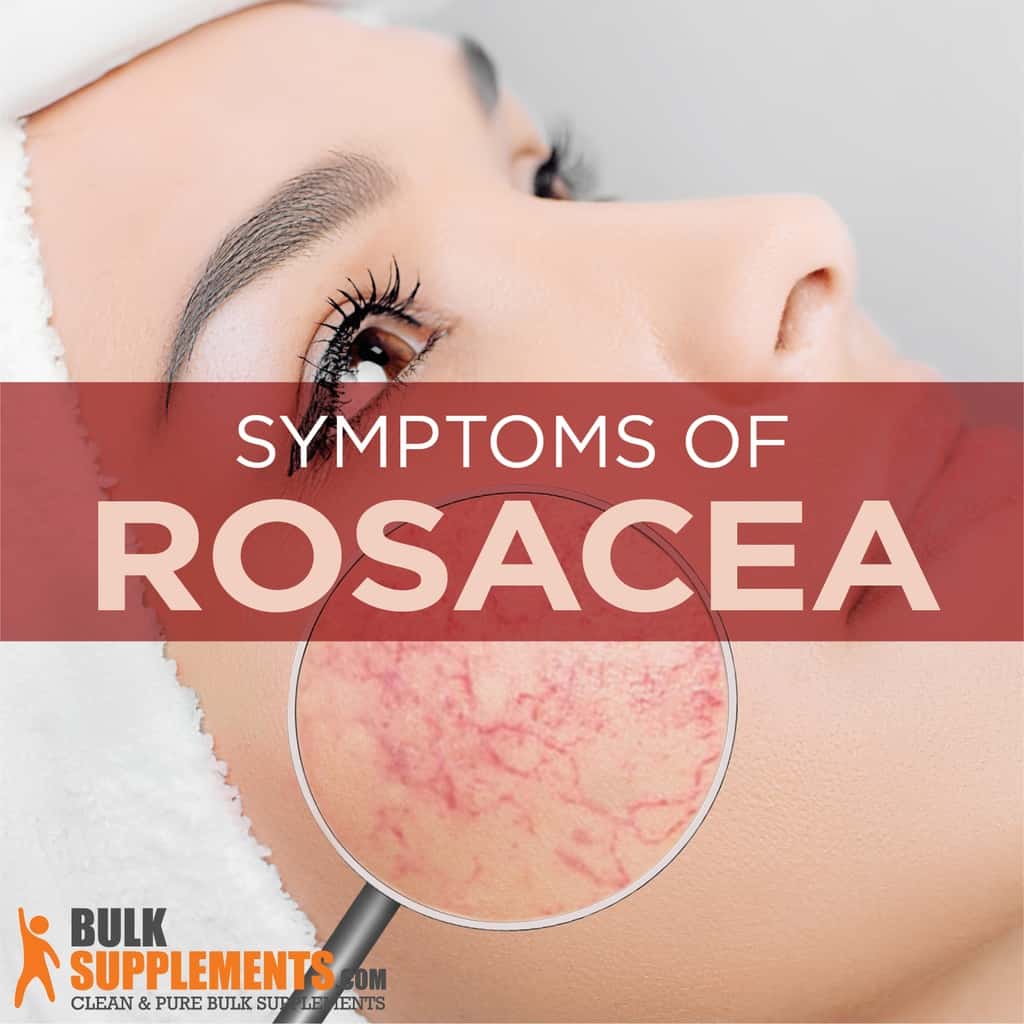 Rosacea Symptoms Causes And Treatment