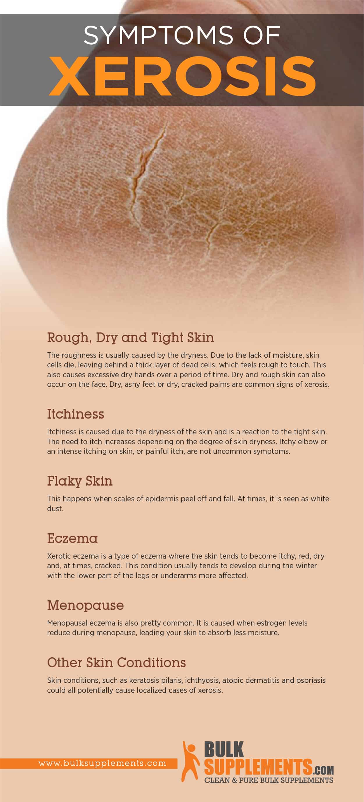 Xerosis Of Skin Pictures