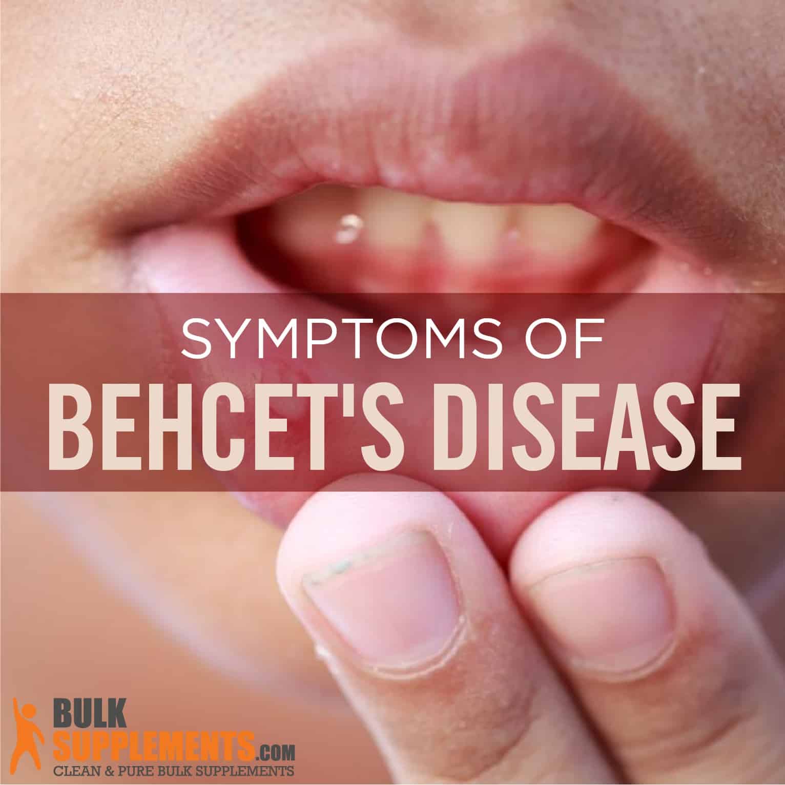 Behcet’s Disease: Symptoms, Causes & Treatment by James Denlinger