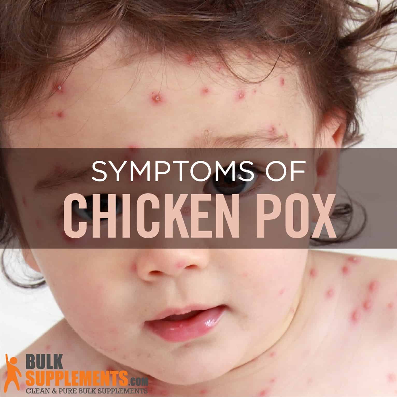 chicken pox virus