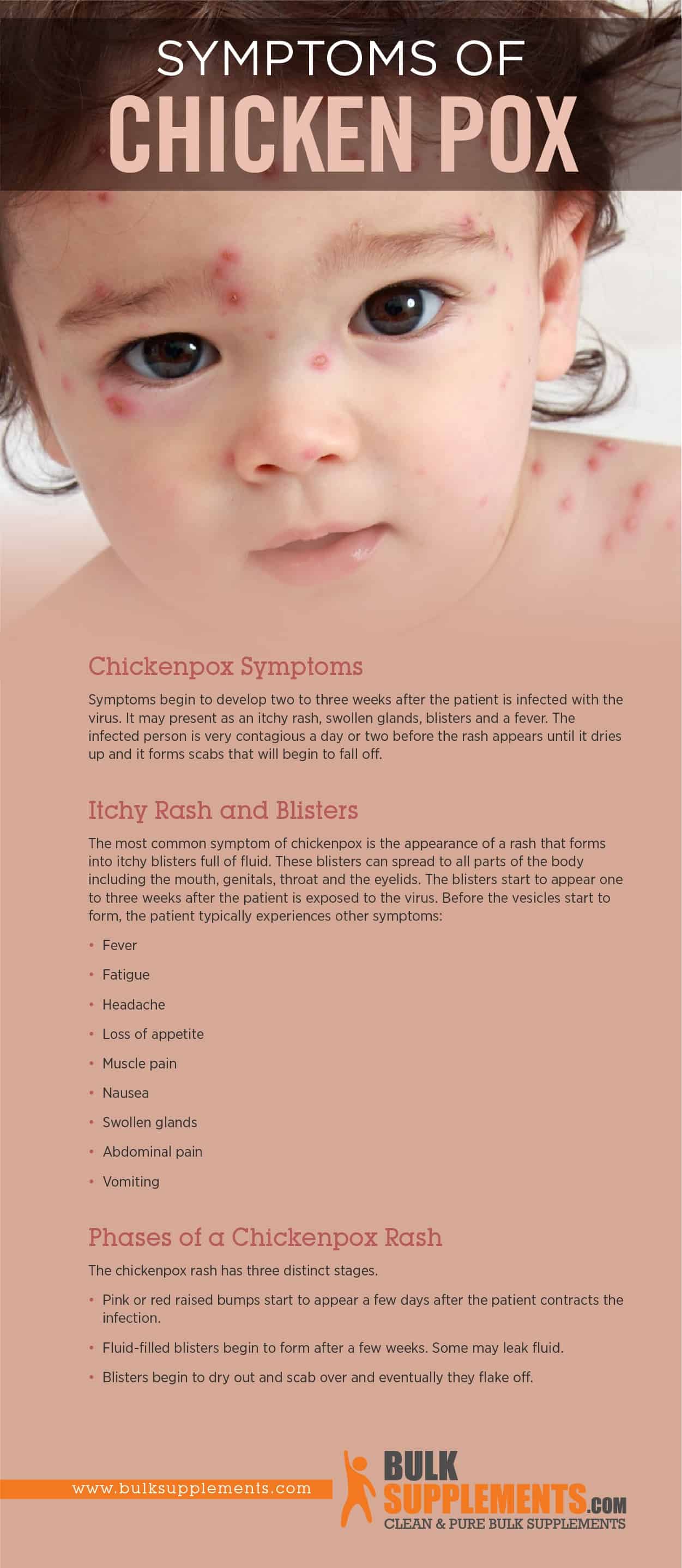 Symptoms of Chicken Pox