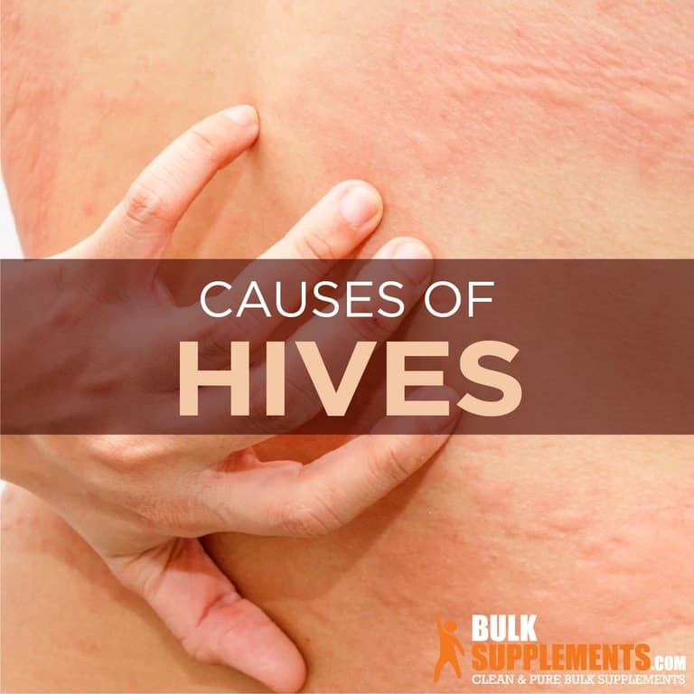 hives-symptoms-causes-treatment