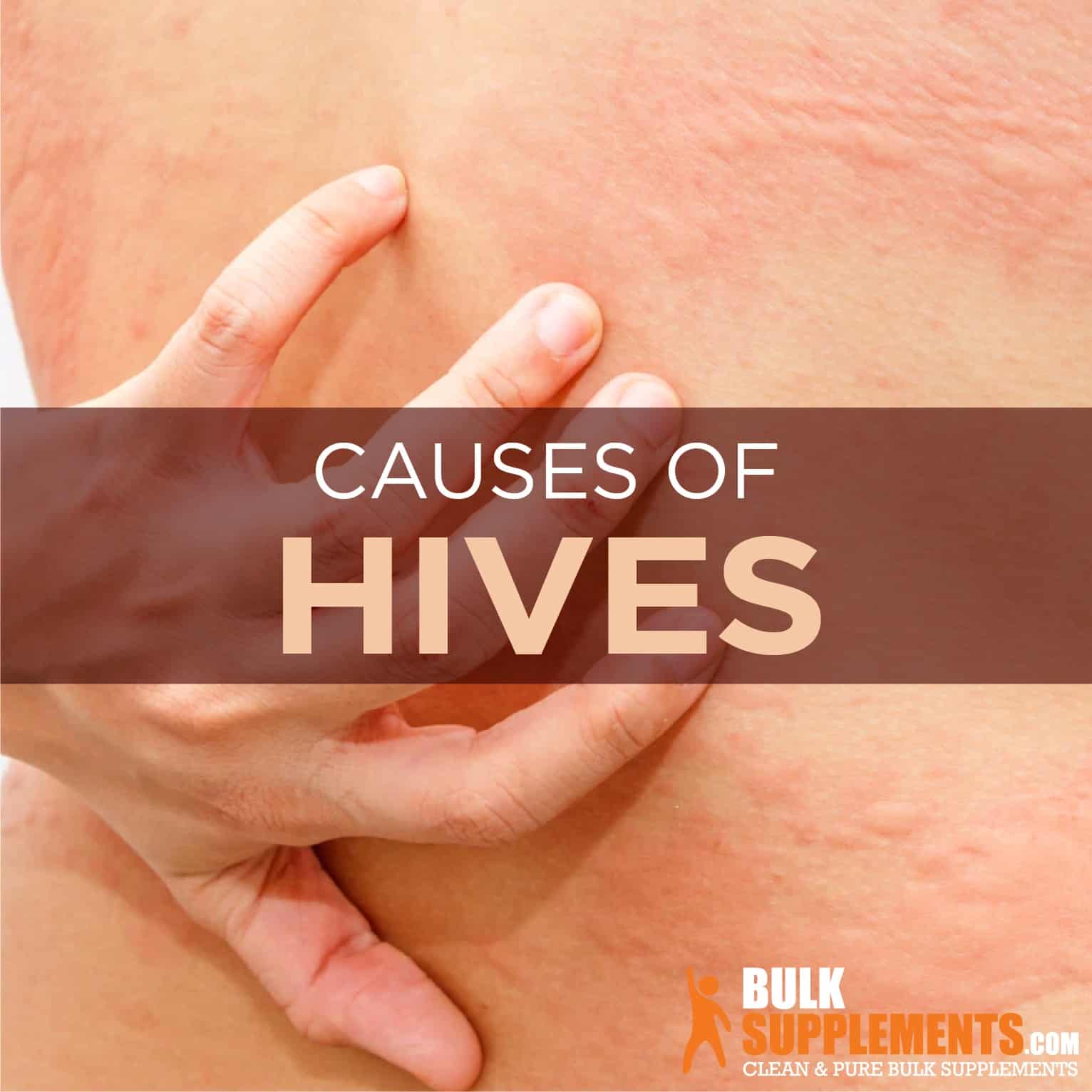 Hives 