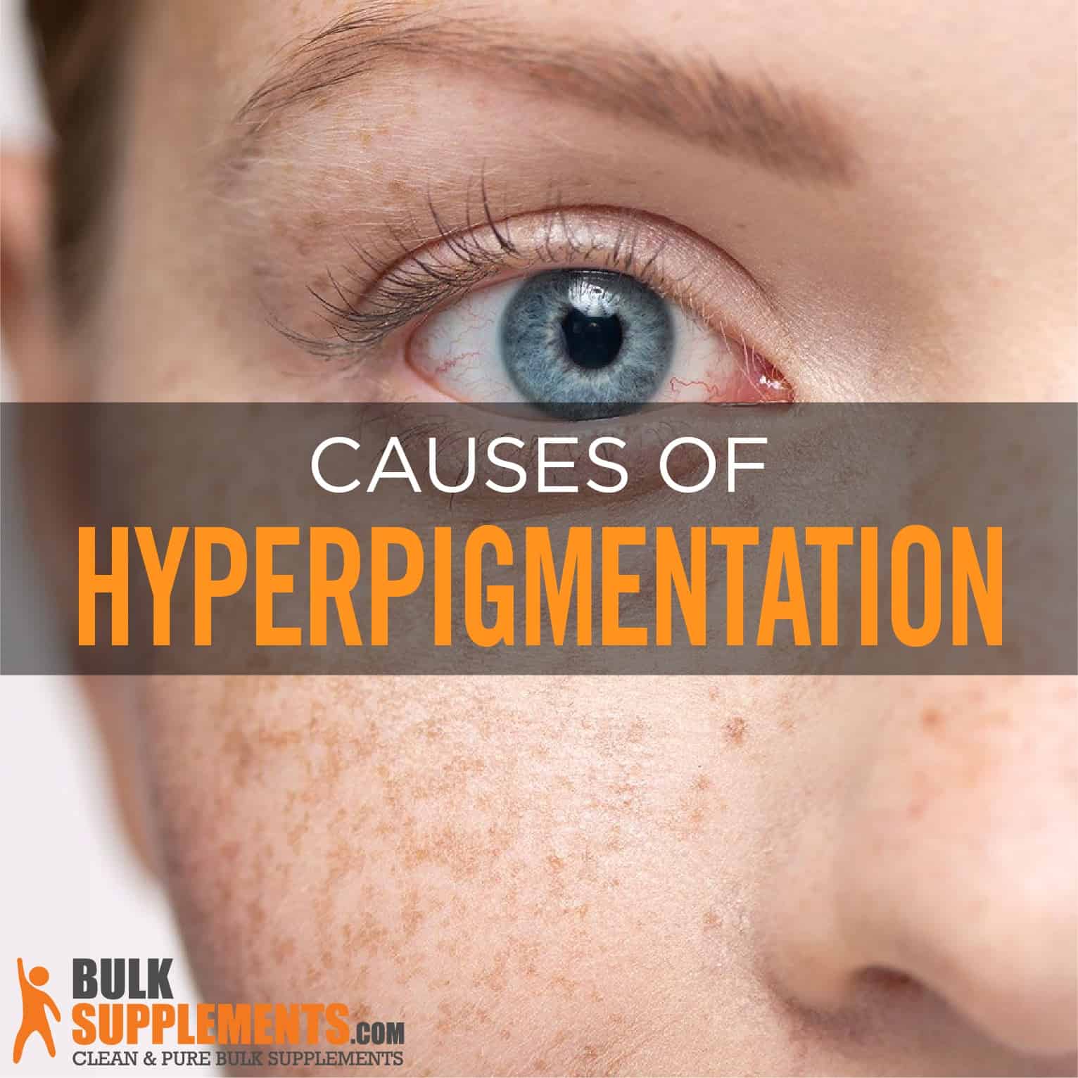 Causes of Hyperpigmentation Under the Eyes