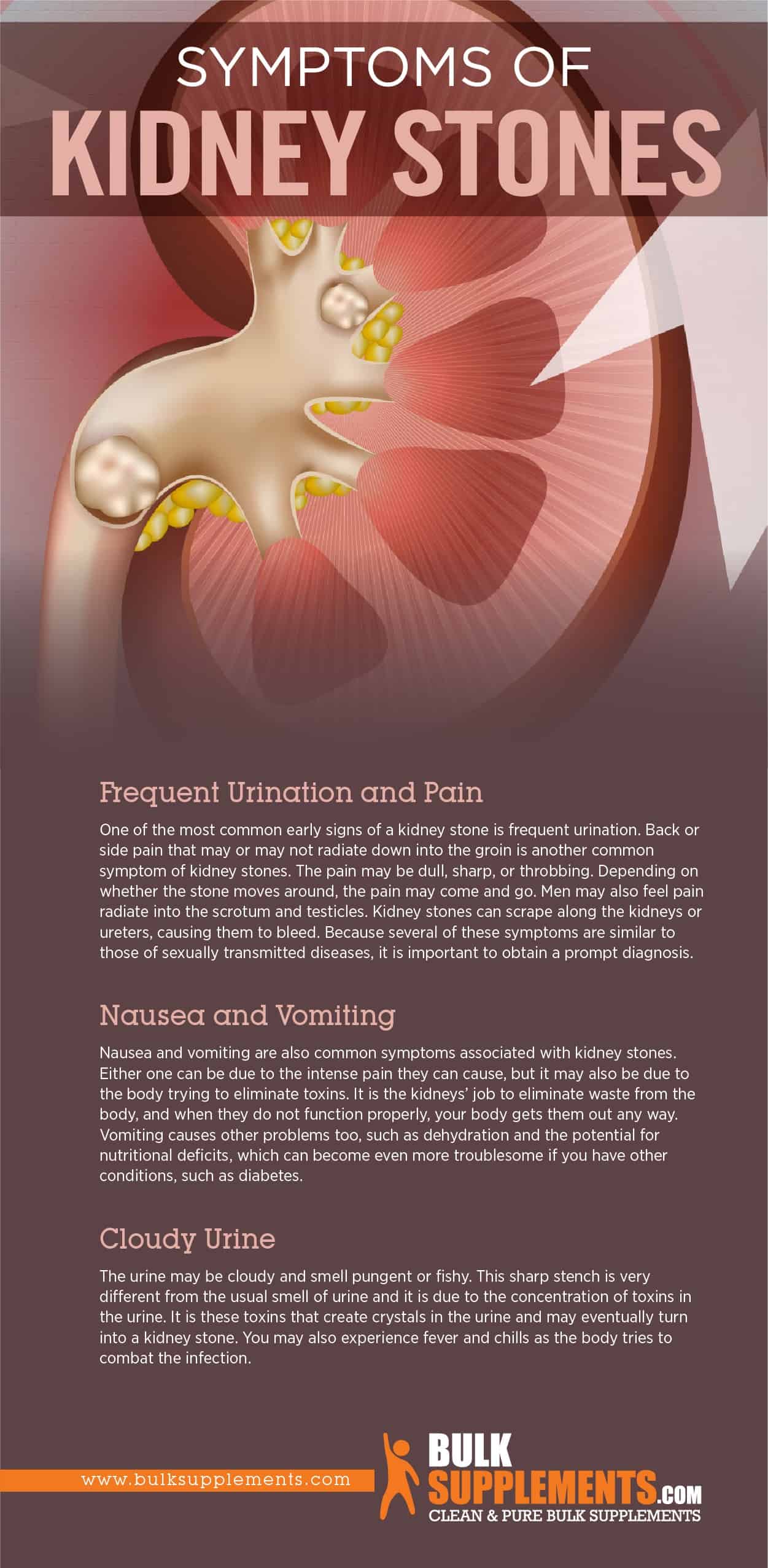 presentation on kidney stones