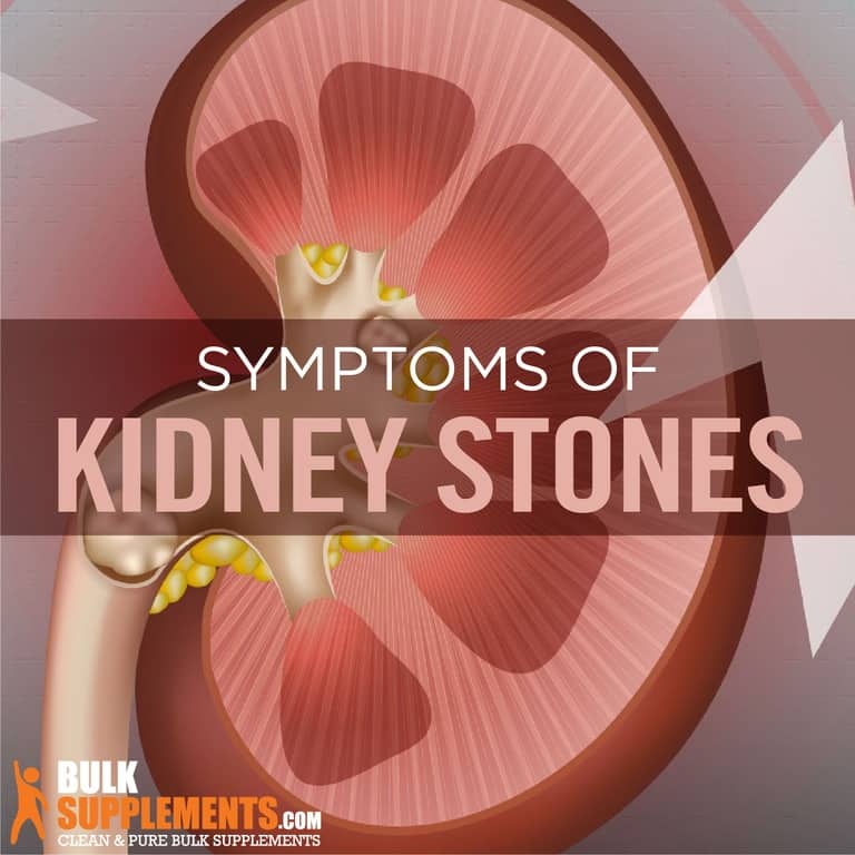 Kidney Stones: Symptoms, Causes & Treatment