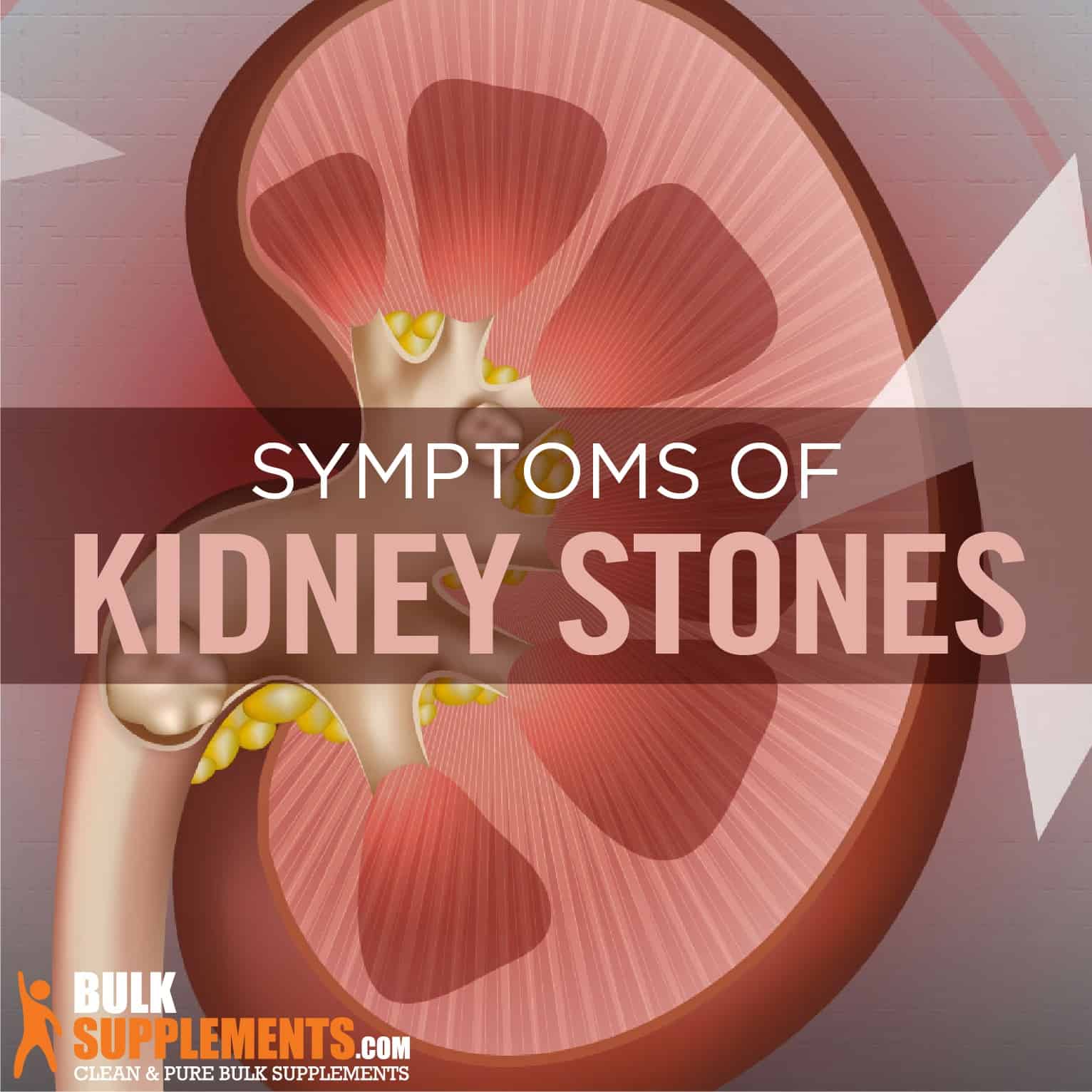 Kidney Stones (Nephrolithiasis) - Symptoms and Causes