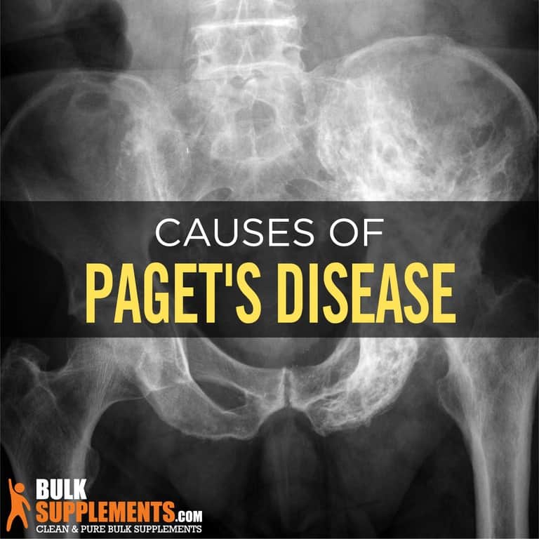 Paget's Disease Symptoms, Causes & Treatment