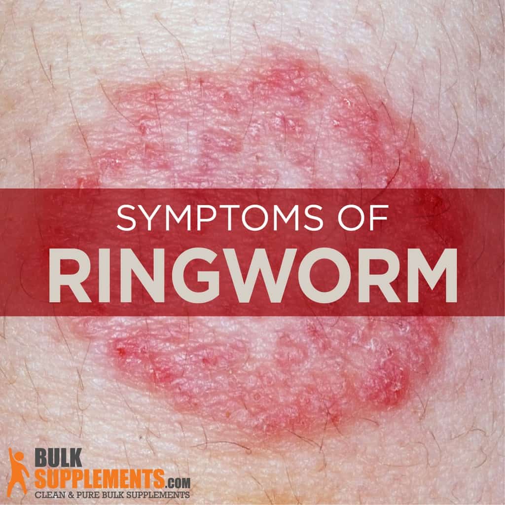 Ringworm in babies: what is it and how to treat it | BabyCenter