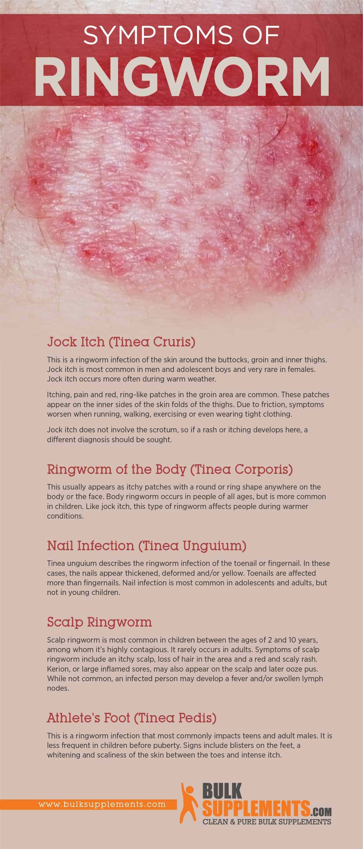 Symptoms of Ringworm