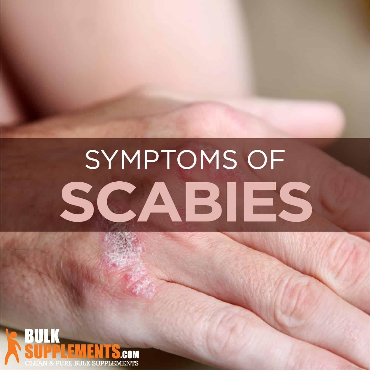 scabies rash on hands