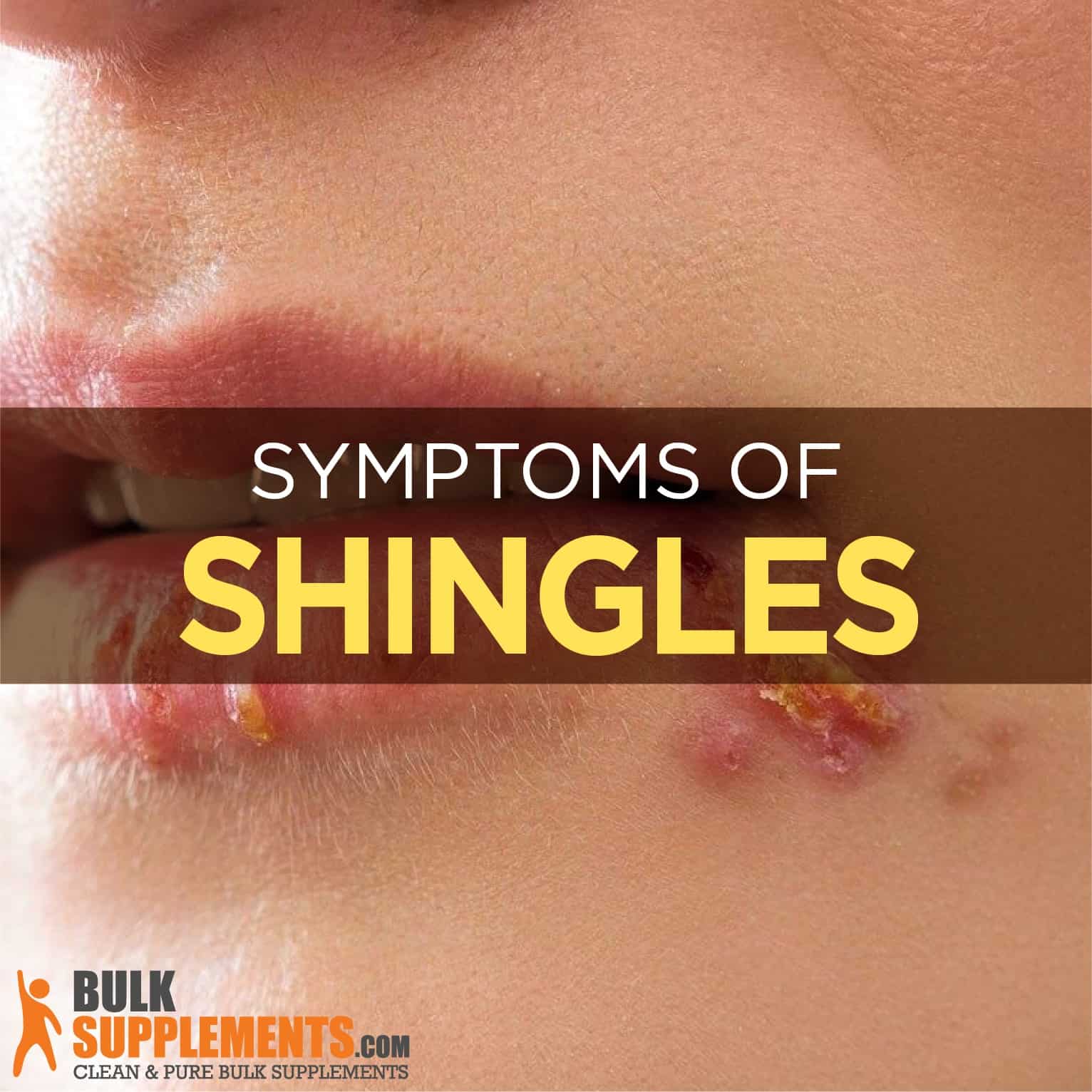 shingles symptoms treatment