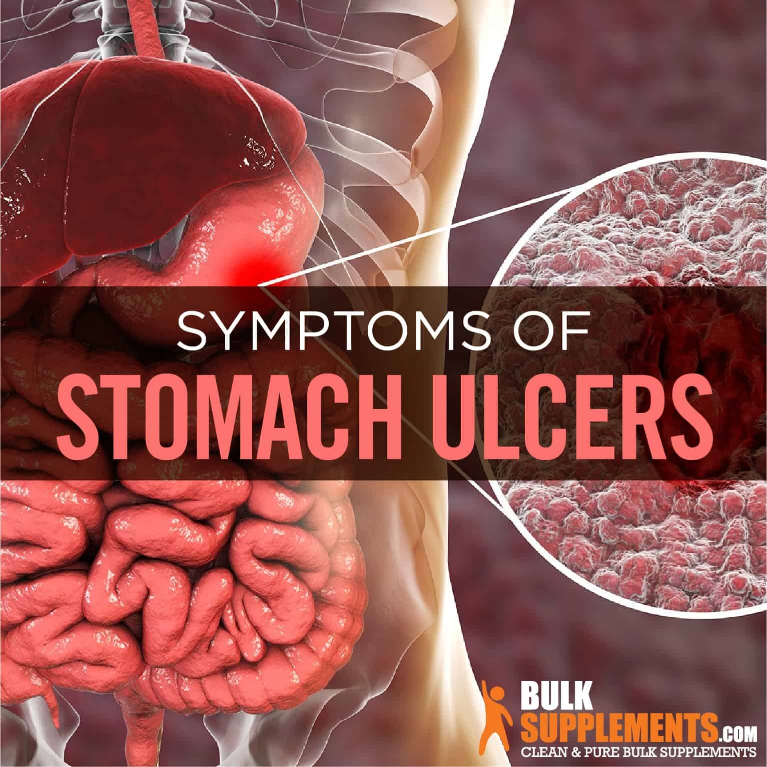 Stomach Ulcers: Causes, Symptoms & Treatment by James Denlinger