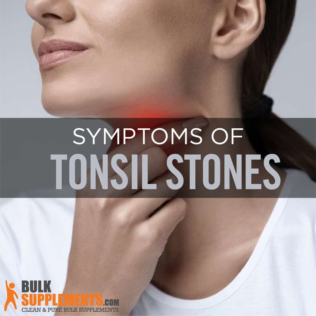 Tonsilloliths Tonsil Stones Risk Factors Symptoms And Treatment