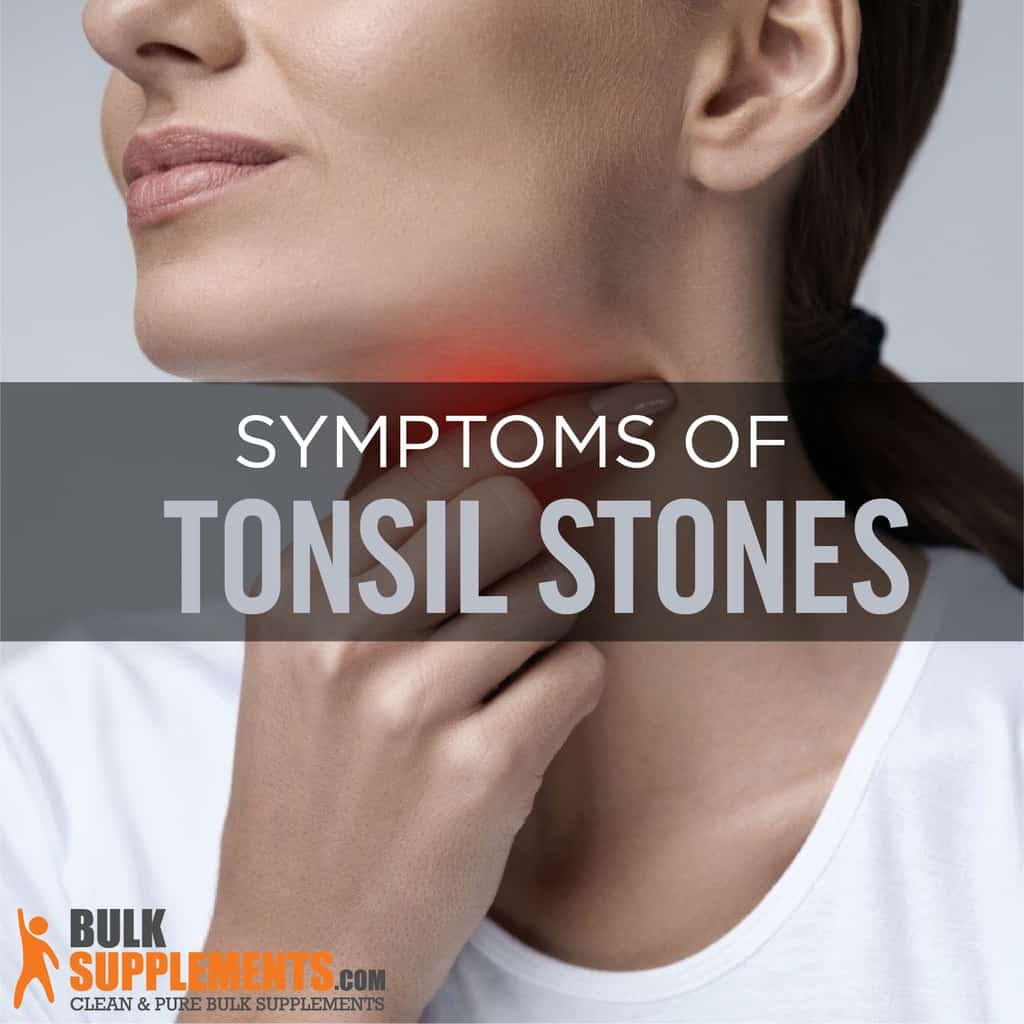 Tonsilloliths Tonsil Stones Risk Factors Symptoms Treatment