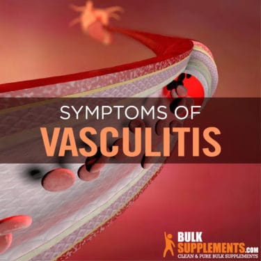 Vasculitis Treatment