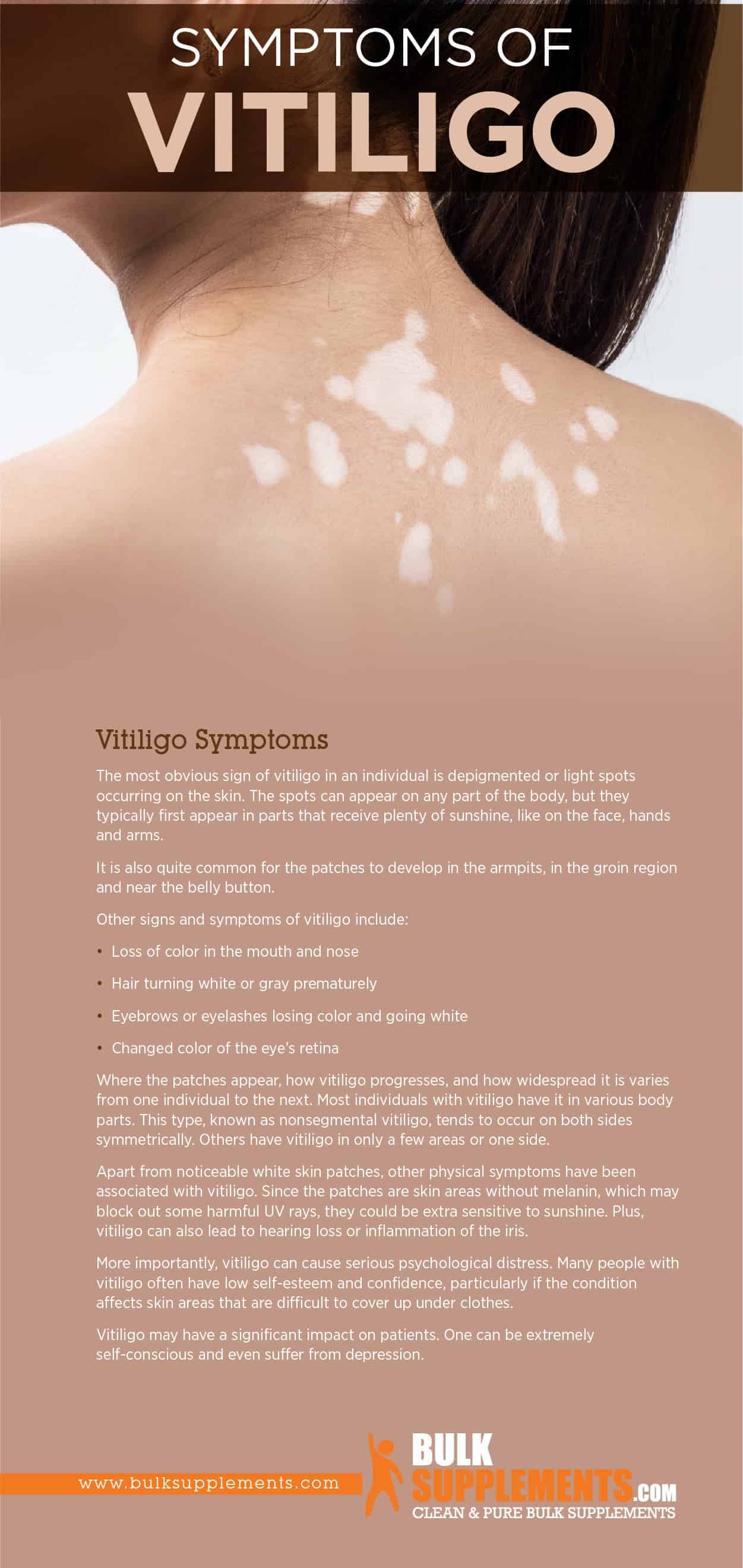 Vitiligo Symptoms